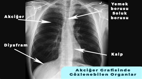 akciğer grafisi için hangi bölüme gidilir